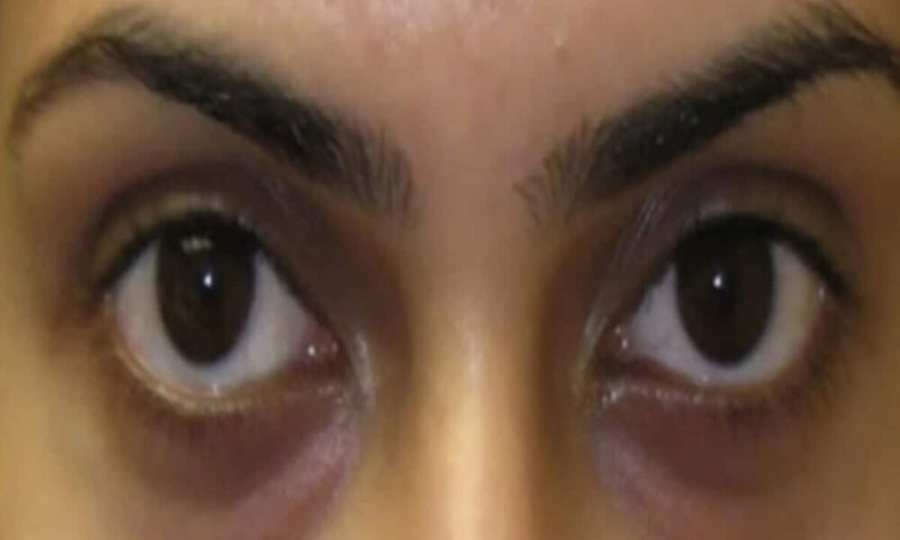 Dark Circles Natural Remedies: know quick home remedies for dark circles in hindi