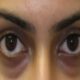 Dark Circles Natural Remedies: know quick home remedies for dark circles in hindi