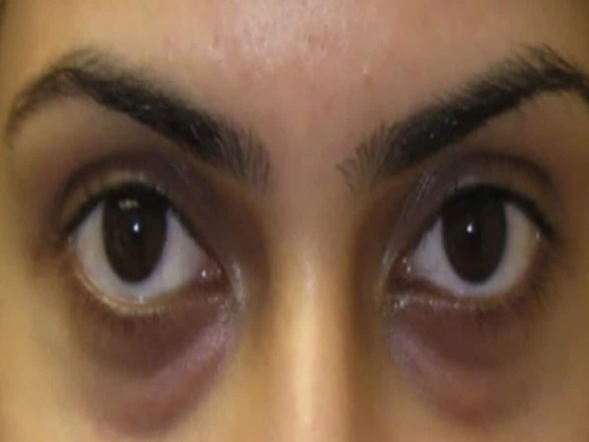 Dark Circles Natural Remedies: know quick home remedies for dark circles in hindi Dark Circles Natural Remedies: know quick home remedies for dark circles in hindi