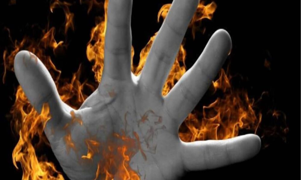 पेट्रोल छिड़ककर महिला को जिंदा जलाने का प्रयास, चेहरा झुलसा