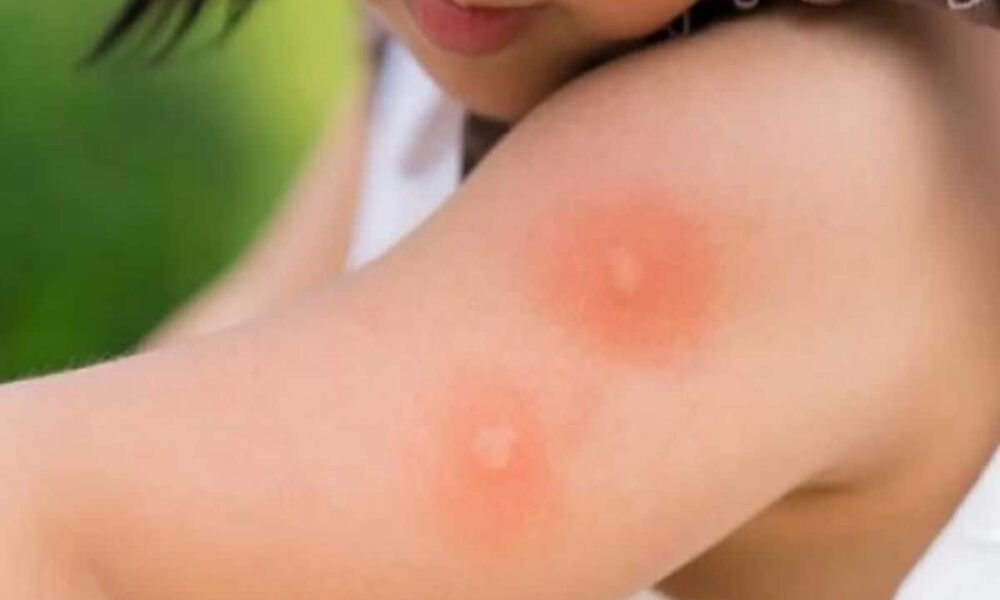 Mosquito Repellent: Best Home Remedies for Mosquitoes You Must try machar bhagane ke upay