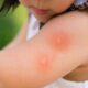 Mosquito Repellent: Best Home Remedies for Mosquitoes You Must try machar bhagane ke upay
