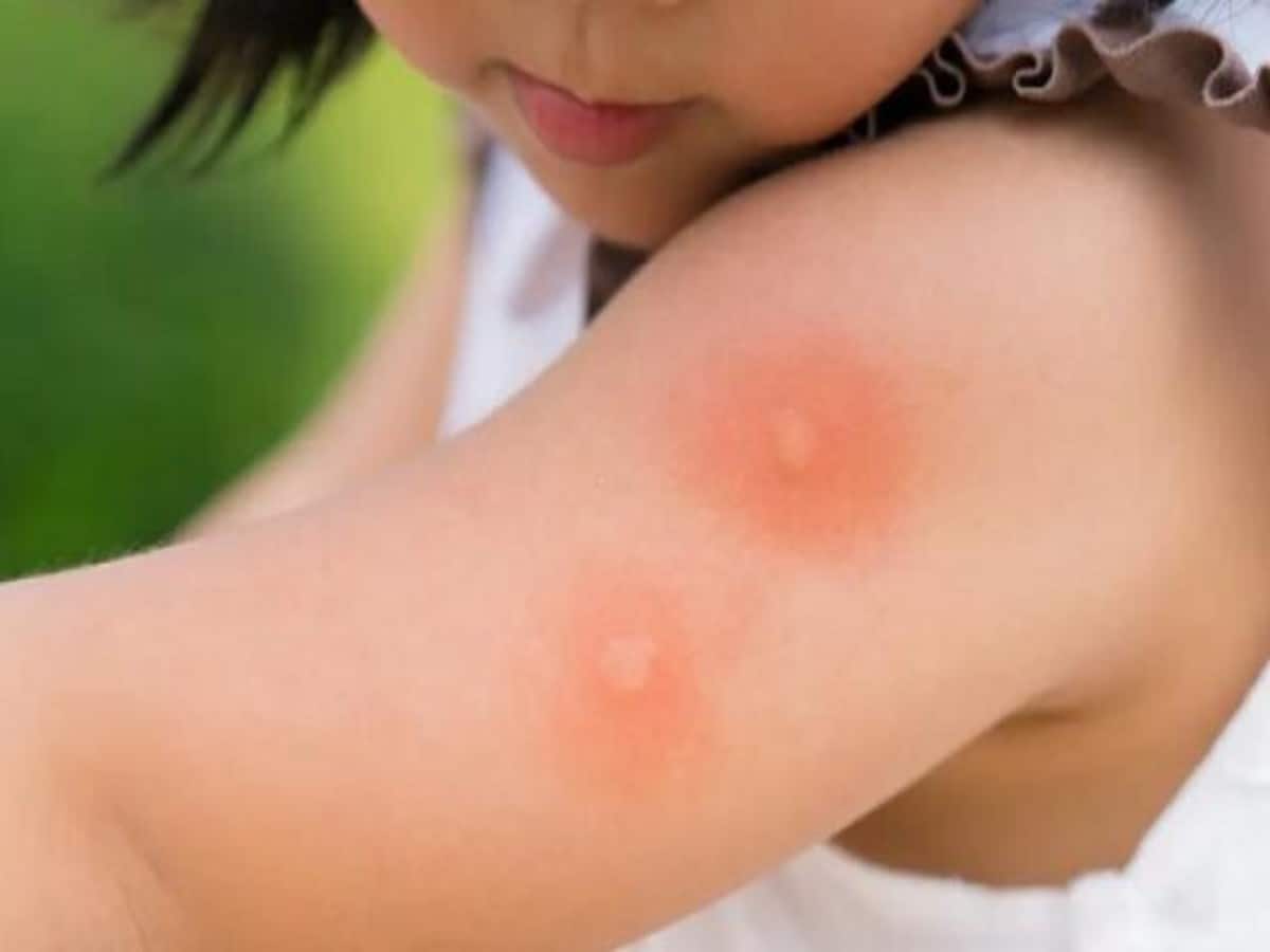 Mosquito Repellent: Best Home Remedies for Mosquitoes You Must try machar bhagane ke upay Mosquito Repellent: Best Home Remedies for Mosquitoes You Must try machar bhagane ke upay