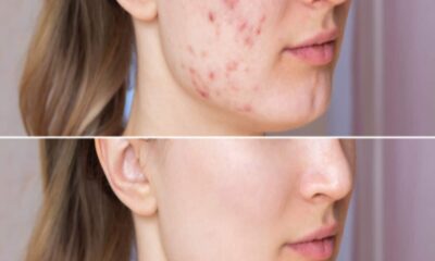 effective ayurvedic remedies to remove pimple from face know right way to apply