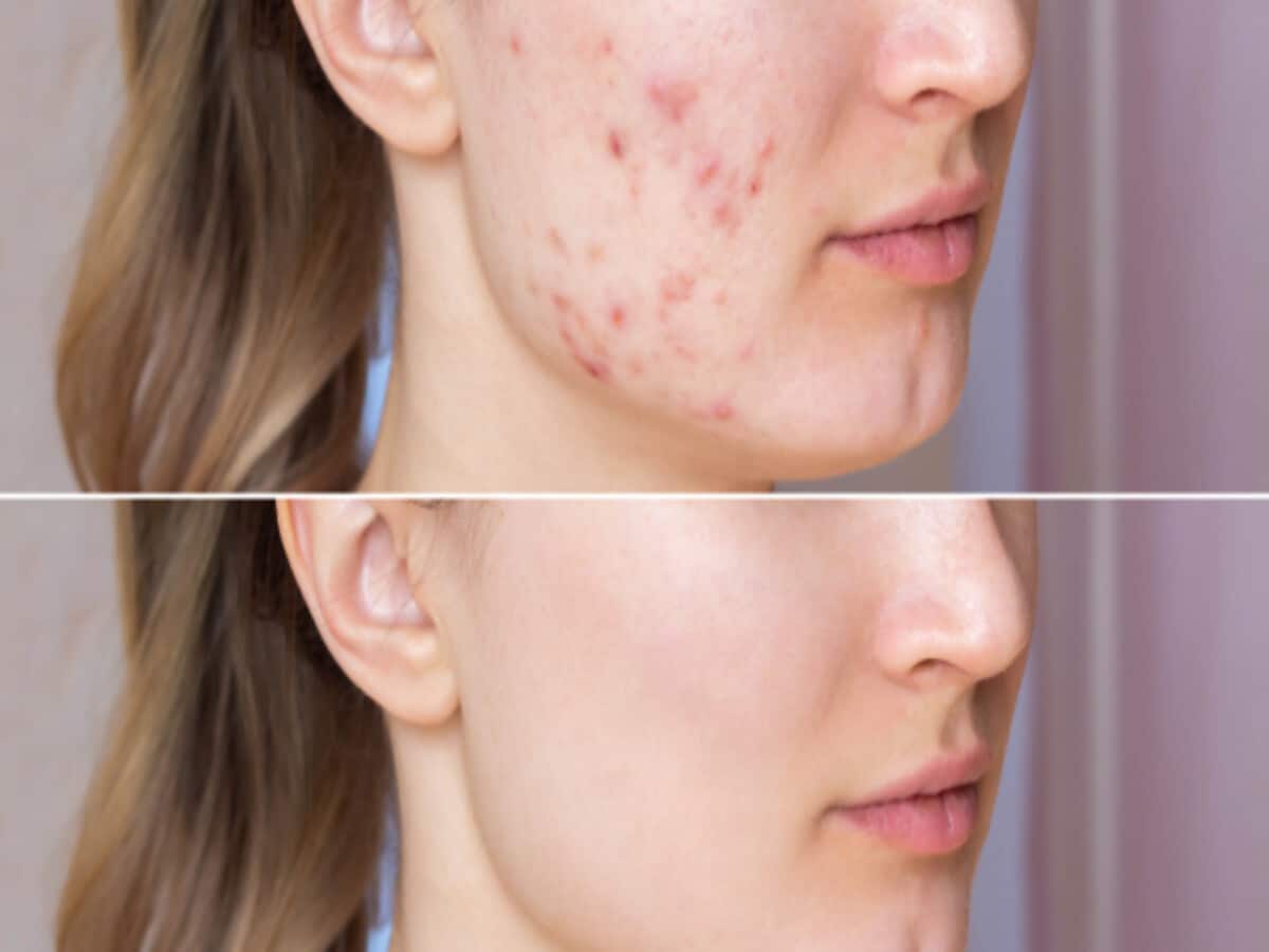 effective ayurvedic remedies to remove pimple from face know right way to apply effective ayurvedic remedies to remove pimple from face know right way to apply