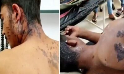 लड़की को किडनैप करने एसिड लेकर पहुंचे, खुद ही जल गए बदमाश; केस दर्ज